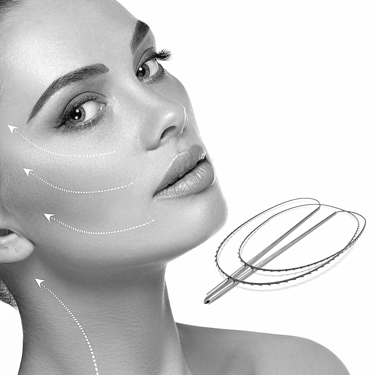 лифтинг нитями Aptos.jpg